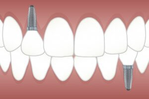 Image of a dental implant, showing the screw (root) and the crown (tooth).